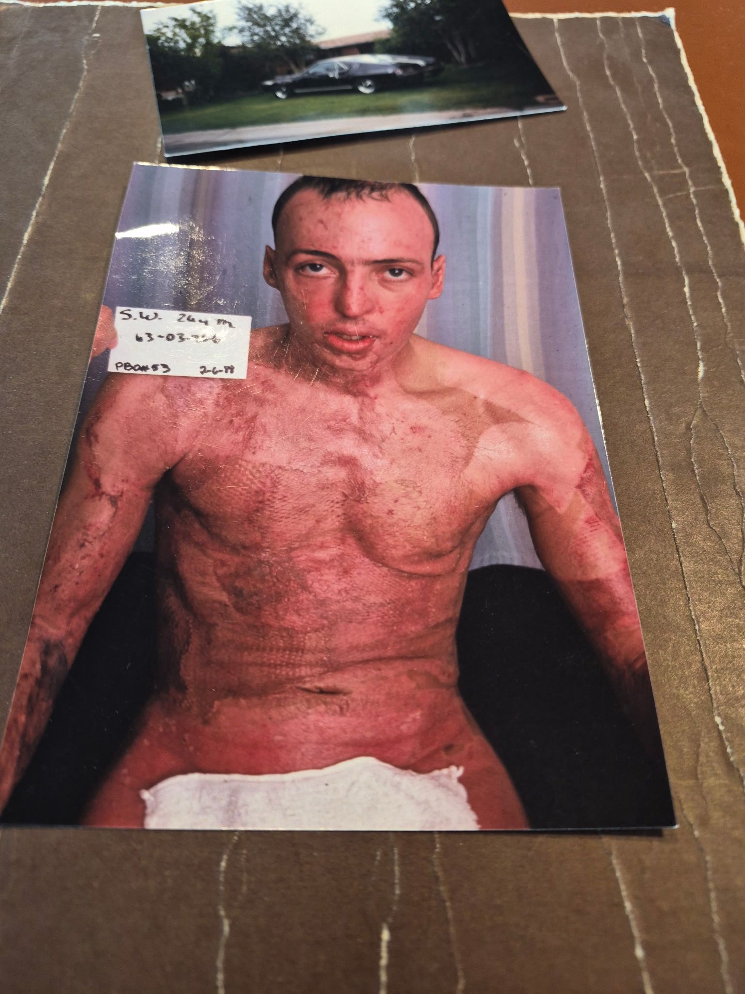 Scott Wolt in the burn unit 1988 — medical photograph showing severe 80%+ burns